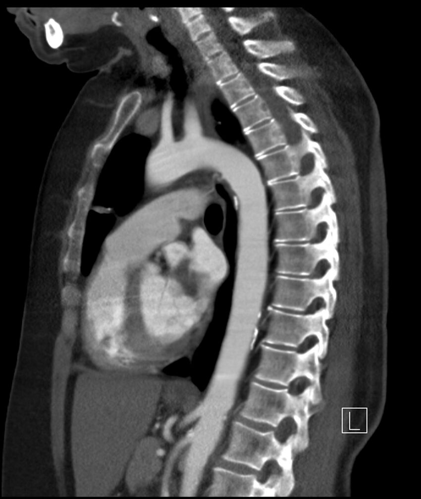 Adenocarcinoma of the lung (Radiopaedia 44205-47803 Sagittal C+ portal venous phase 26).jpg