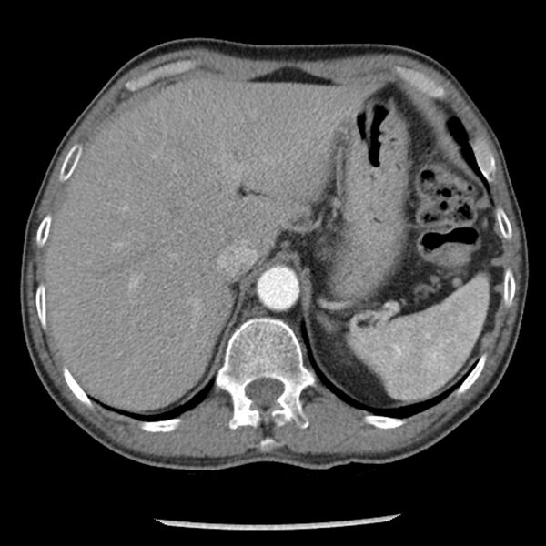 File:Adenocarcinoma of the lung - micropapillary predominant (Radiopaedia 42446-45563 Axial C+ portal venous phase 69).jpg