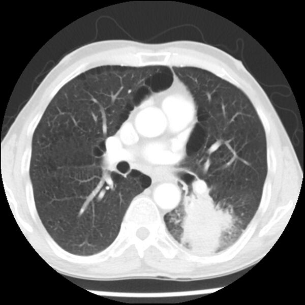 File:Adenocarcinoma of the lung - micropapillary predominant (Radiopaedia 42446-45563 Axial lung window 36).jpg