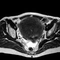 Adenomyoma of the uterus (huge) (Radiopaedia 9870-10438 Axial T2 20).jpg
