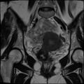 Adenomyosis and endometriotic cysts (Radiopaedia 82300-96367 Coronal T2 21).jpg