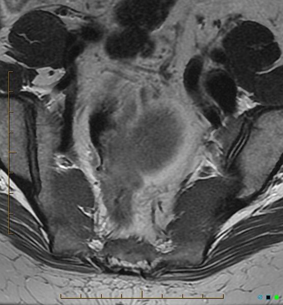 File:Adenomyosis uterus with hematometra (Radiopaedia 45779-50011 Axial T2 4).jpg
