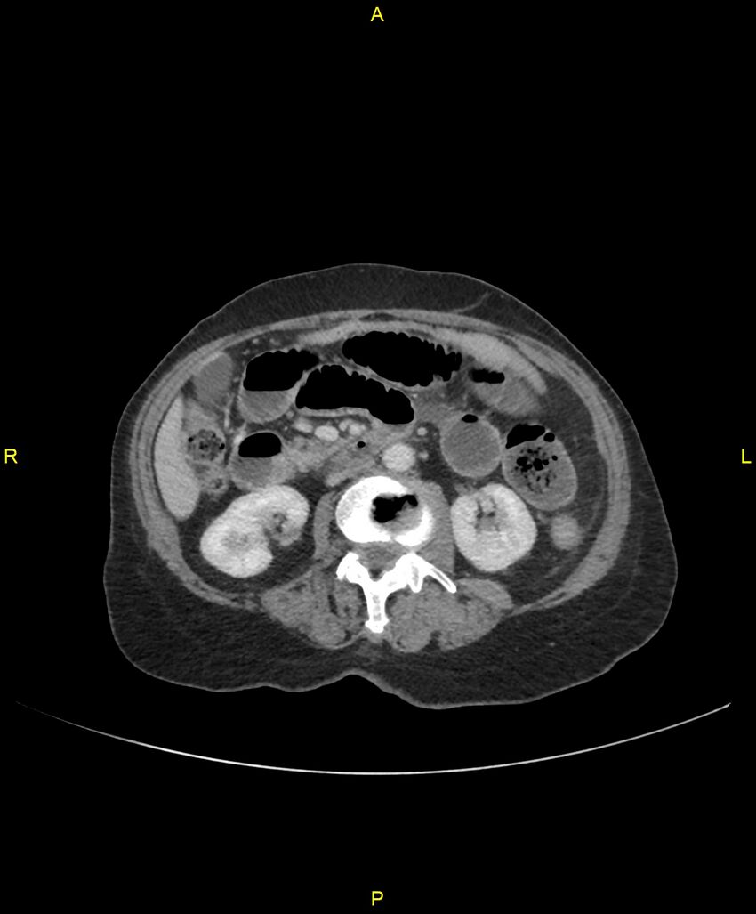 Adhesional small bowel obstruction (Radiopaedia 85402-101024 Axial C+ portal venous phase 125).jpg