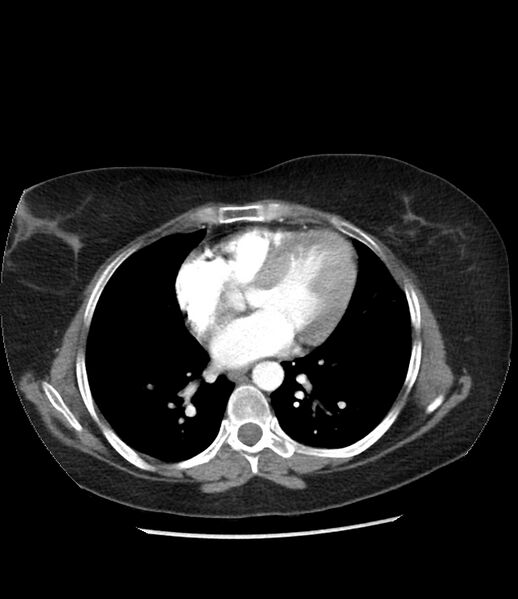 File:Adrenal cortical carcinoma with IVC invasion and thrombosis (Radiopaedia 34307-35597 Axial C+ arterial phase 2).jpg