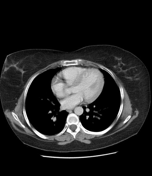 File:Adrenal cortical carcinoma with IVC invasion and thrombosis (Radiopaedia 34307-35597 Axial C+ portal venous phase 1).jpg