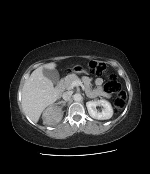 File:Adrenal cortical carcinoma with IVC invasion and thrombosis (Radiopaedia 34307-35597 Axial C+ portal venous phase 29).jpg