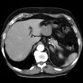 Adrenal hemangioma (Radiopaedia 11039-11445 Axial C+ arterial phase 3).jpg