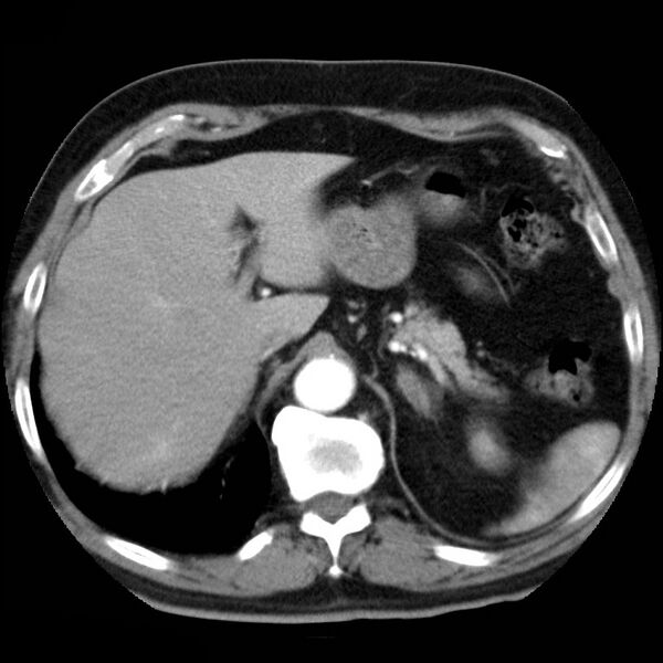 File:Adrenal hemangioma (Radiopaedia 11039-11445 Axial C+ arterial phase 3).jpg