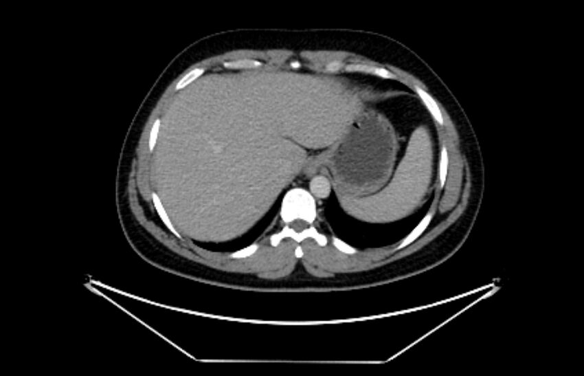 Adrenocortical carcinoma (Radiopaedia 80134-93438 Axial C+ portal venous phase 24).jpg