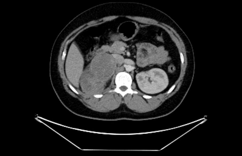 File:Adrenocortical carcinoma (Radiopaedia 80134-93438 Axial C+ portal venous phase 50).jpg