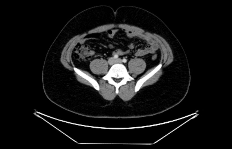 File:Adrenocortical carcinoma (Radiopaedia 80134-93438 Axial C+ portal venous phase 88).jpg