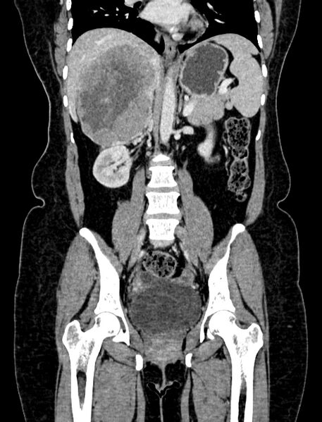 File:Adrenocortical carcinoma (Radiopaedia 87281-103569 Coronal C+ portal venous phase 61).jpg