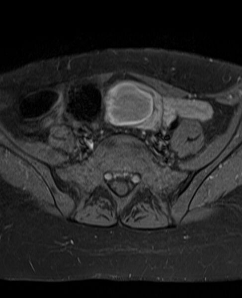 File:Adult granulosa cell tumor of the ovary (Radiopaedia 71581-81950 Axial T1 C+ fat sat 7).jpg