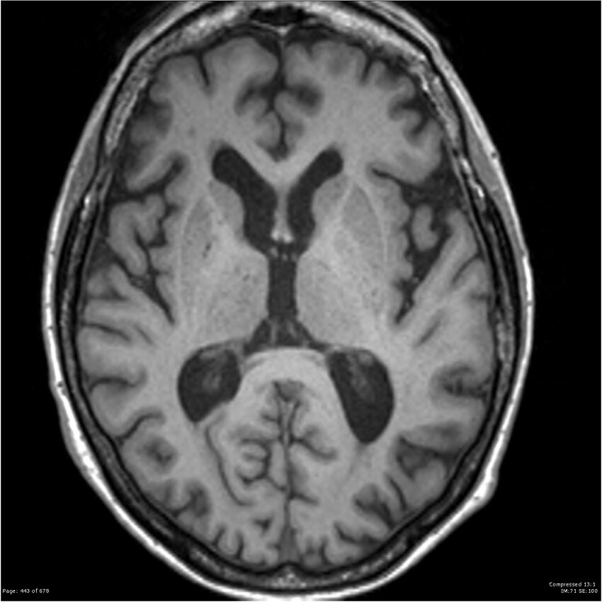 Alzheimer disease (Radiopaedia 22196-22226 Axial T1 35).jpg