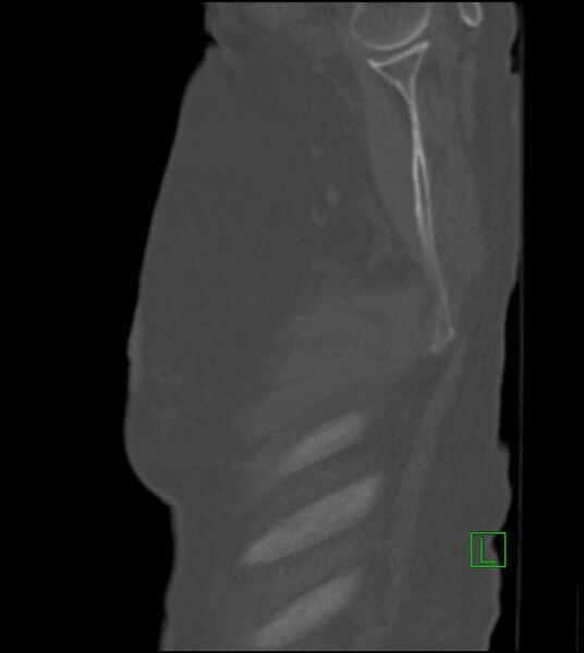 File:Amiodarone deposition in the liver (Radiopaedia 77587-89780 Sagittal bone window 89).jpg