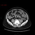 Ampullary carcinoma (Radiopaedia 56396-63056 C 67).jpg