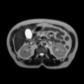 Ampullary tumor (Radiopaedia 27294-27479 T2 6).jpg