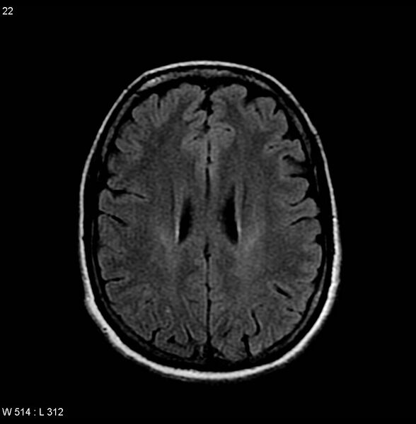 File:Amyotrophic lateral sclerosis (Radiopaedia 4719-6744 Axial FLAIR 6).jpg