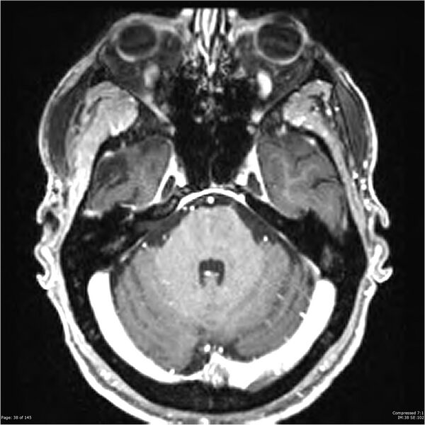 File:Anaplastic meningioma with recurrence (Radiopaedia 34452-35788 Axial T1 C+ 38).jpg