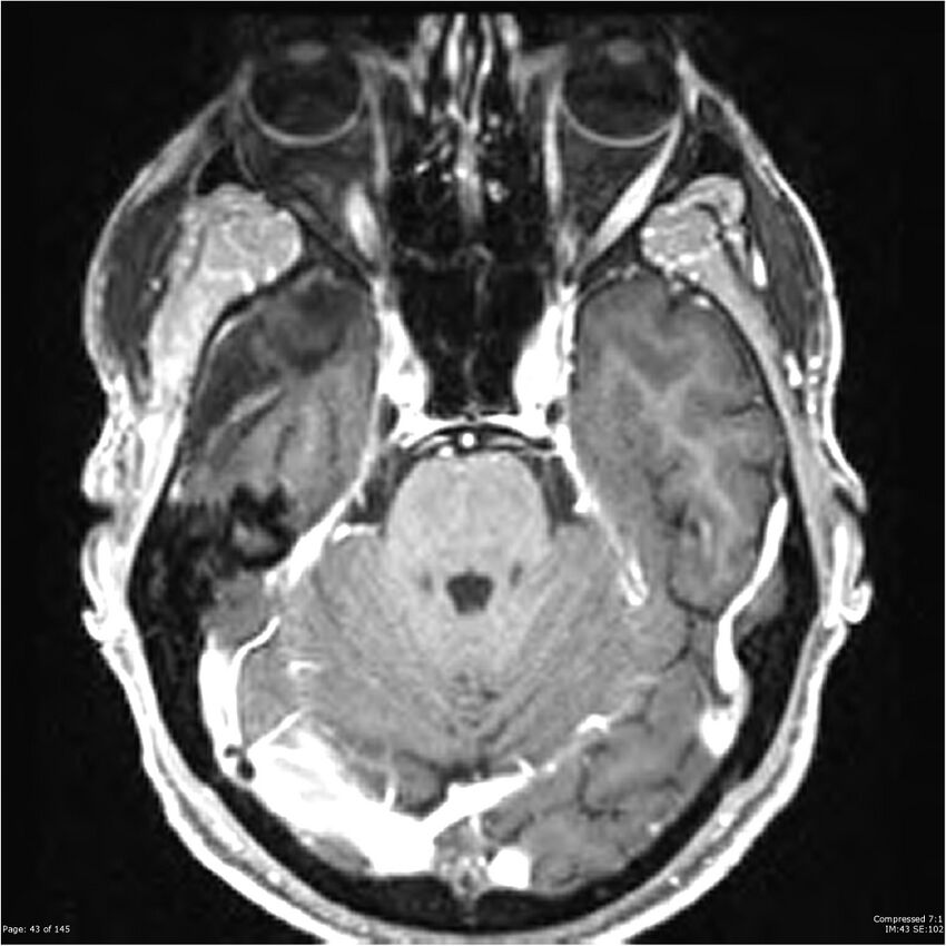Anaplastic meningioma with recurrence (Radiopaedia 34452-35788 Axial T1 C+ 43).jpg