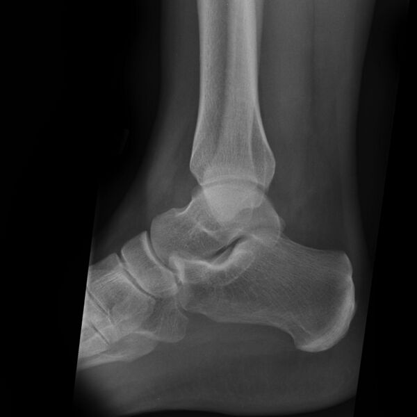 File:Ankle fracture - Weber A (Radiopaedia 7965-8811 Lateral 1).jpg