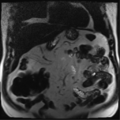 Annular pancreas (Radiopaedia 38292-40320 Coronal T2 26).png