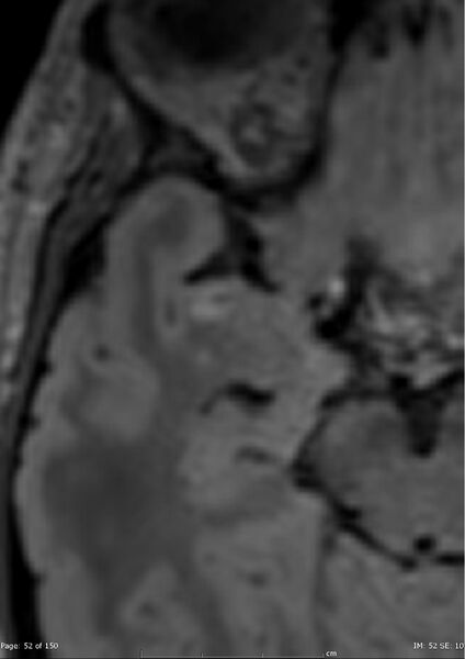 File:Anterior temporal lobe perivascular space (Radiopaedia 40946-43650 C 13).jpg