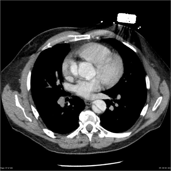 File:Aortic dissection- Stanford A (Radiopaedia 37759-39664 A 38).jpg