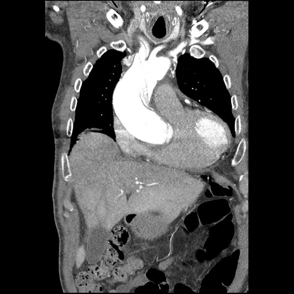 File:Aortic dissection - DeBakey Type I-Stanford A (Radiopaedia 79863-93115 B 11).jpg