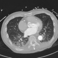 Aortic dissection - DeBakey type II (Radiopaedia 64302-73082 Axial lung window 40).png