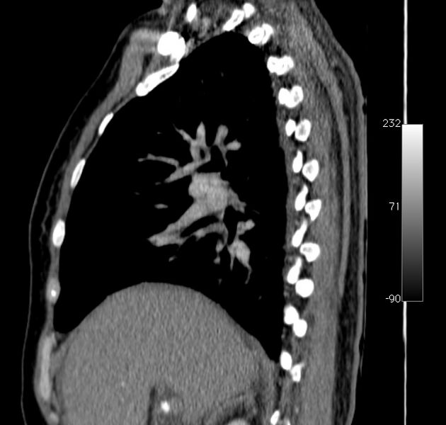 File:Aortic dissection - Stanford type A (Radiopaedia 29247-29659 C 41).jpg