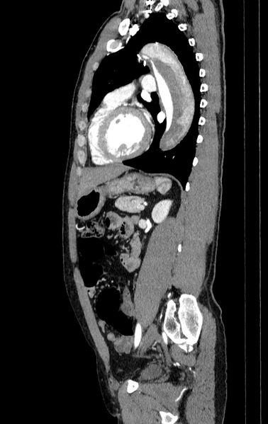 File:Aortic dissection - Stanford type A (Radiopaedia 83418-98500 B 59).jpg