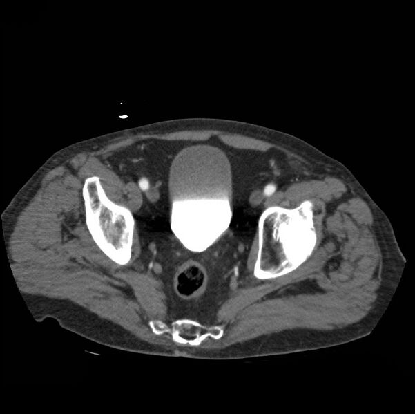 File:Aortic dissection with rupture into pericardium (Radiopaedia 12384-12647 A 83).jpg