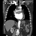 Aortic dissection with rupture into pericardium (Radiopaedia 12384-12647 B 22).jpg
