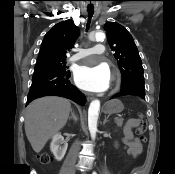 File:Aortic dissection with rupture into pericardium (Radiopaedia 12384-12647 B 22).jpg