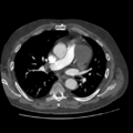 Aorto-coronary bypass graft aneurysms (Radiopaedia 40562-43157 A 53).png