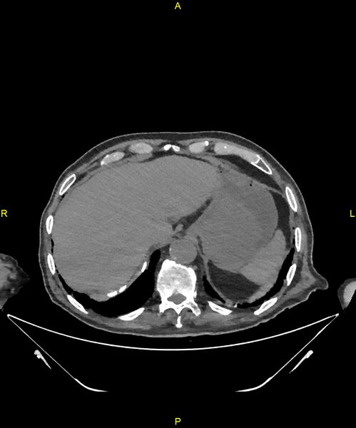 File:Aortoenteric fistula (Radiopaedia 84308-99603 Axial non-contrast 41).jpg