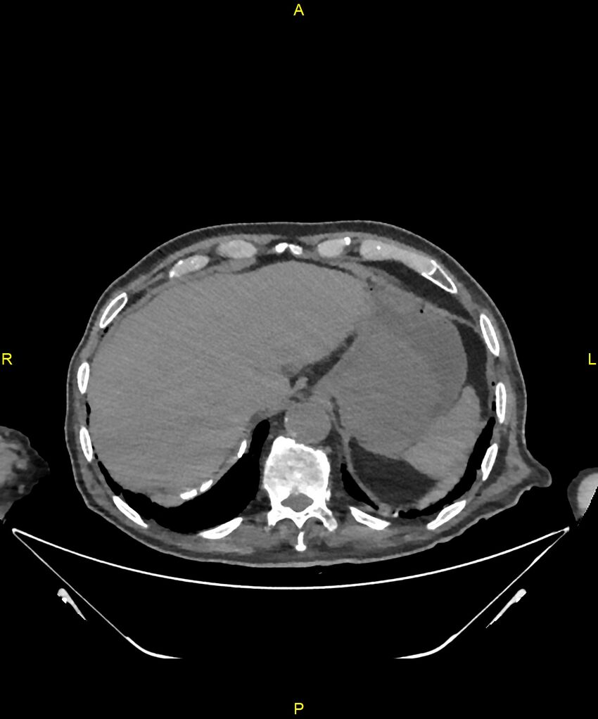 Aortoenteric fistula (Radiopaedia 84308-99603 Axial non-contrast 41).jpg