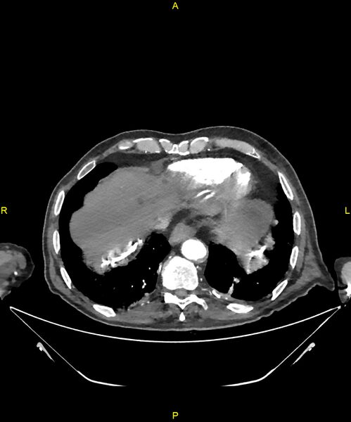 File:Aortoenteric fistula (Radiopaedia 84308-99603 B 17).jpg