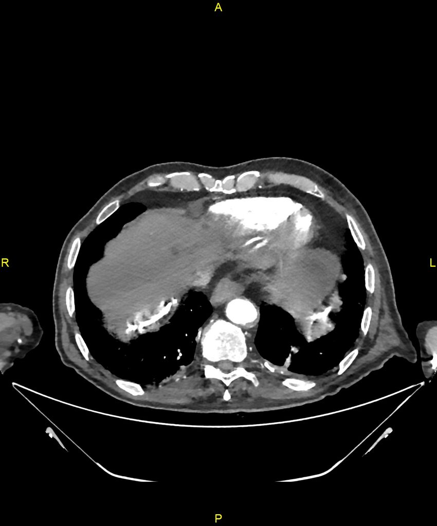 Aortoenteric fistula (Radiopaedia 84308-99603 B 17).jpg
