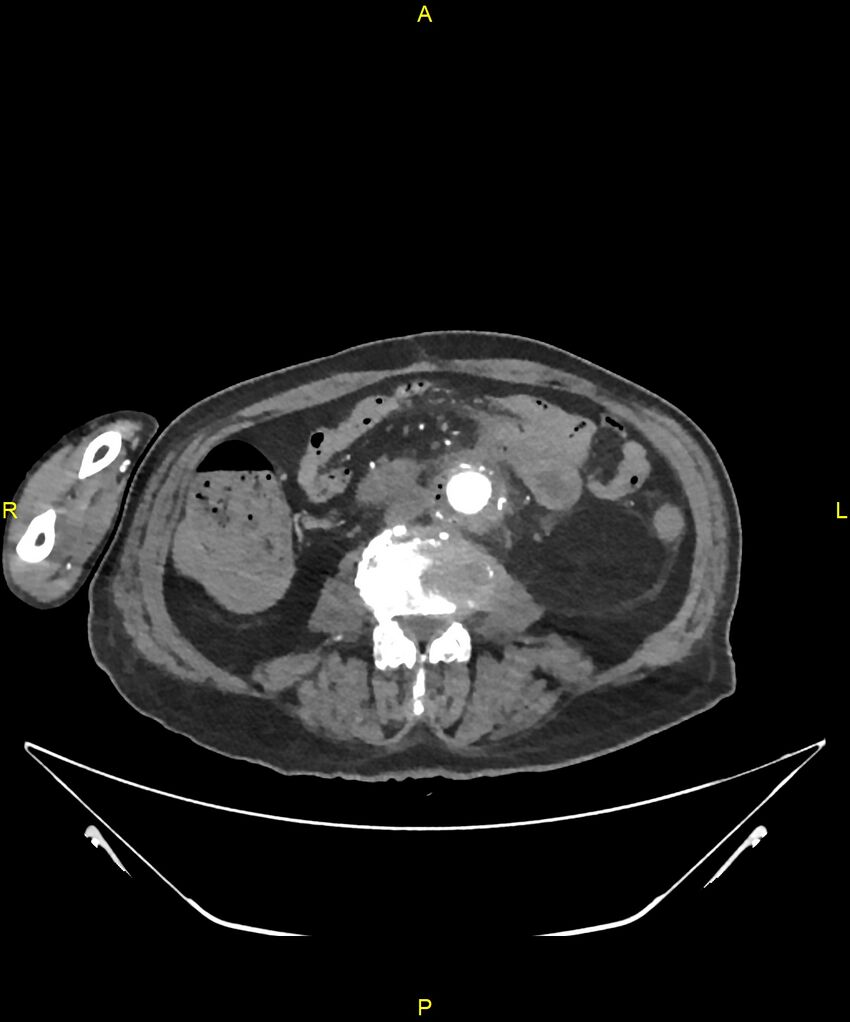 Aortoenteric fistula (Radiopaedia 84308-99603 B 204).jpg