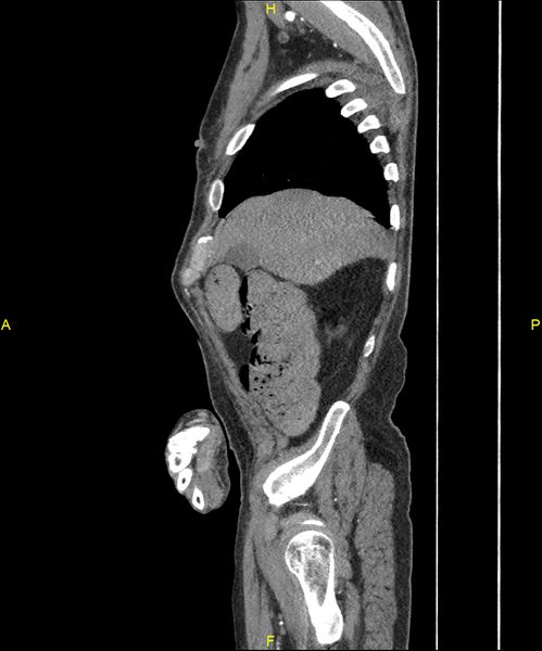 File:Aortoenteric fistula (Radiopaedia 84308-99603 C 59).jpg