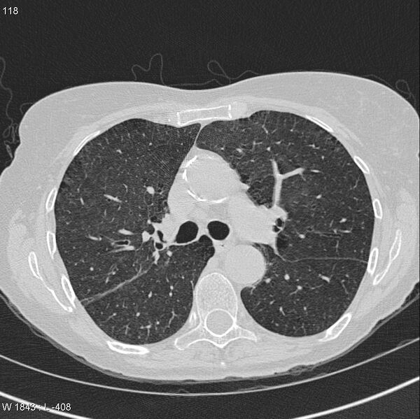 File:Apical non-small-cell lung cancer (Radiopaedia 8570-9405 Axial lung window 19).jpg