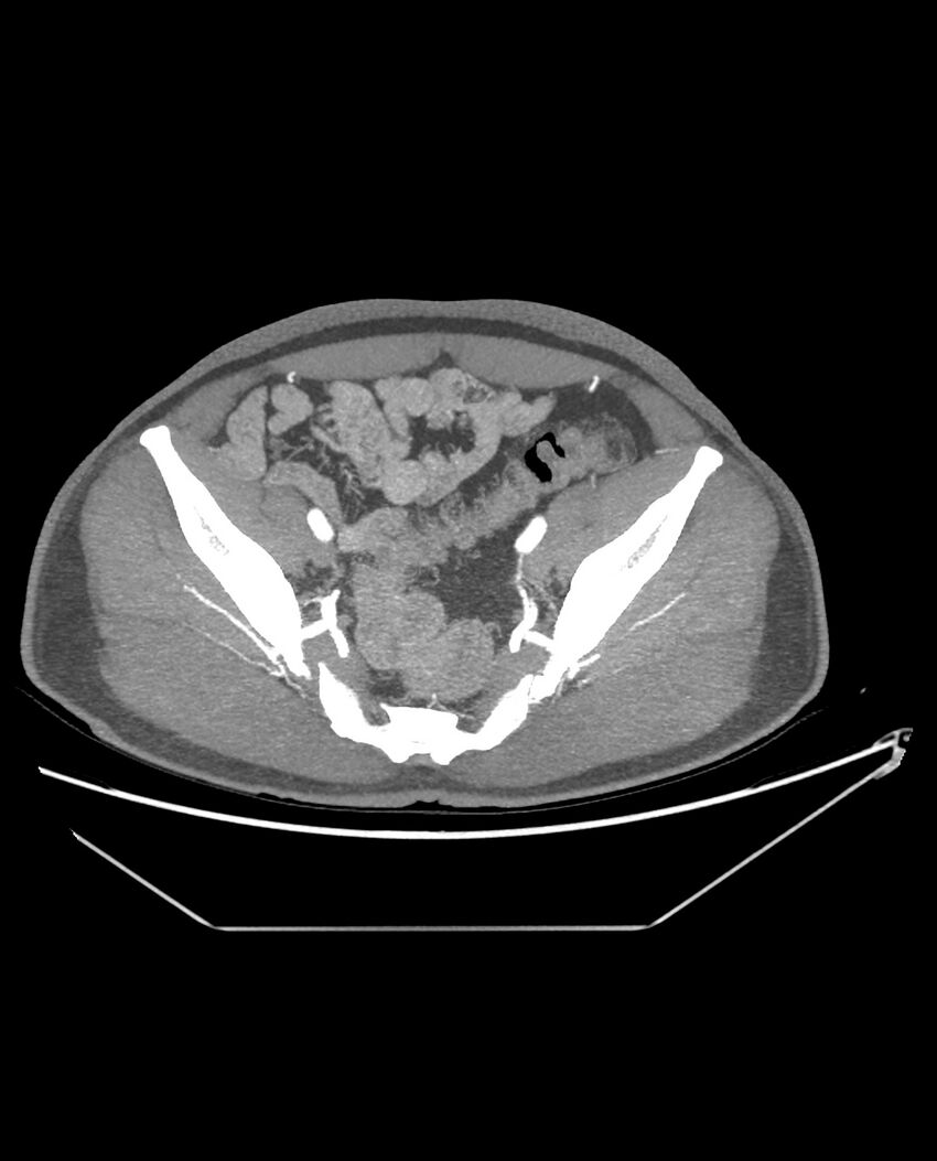 Aplastic posterior tibial arteries (Radiopaedia 84021-99249 A 88).jpg