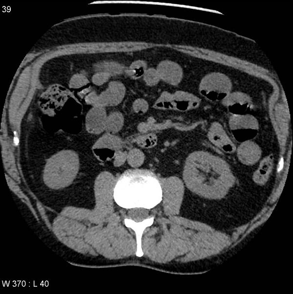 File:Appendicitis (Radiopaedia 12510-12733 Axial non-contrast 6).jpg