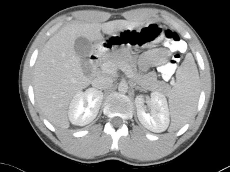 File:Appendicitis and incidental foregut duplication cyst (Radiopaedia 52962-58916 A 5).jpg