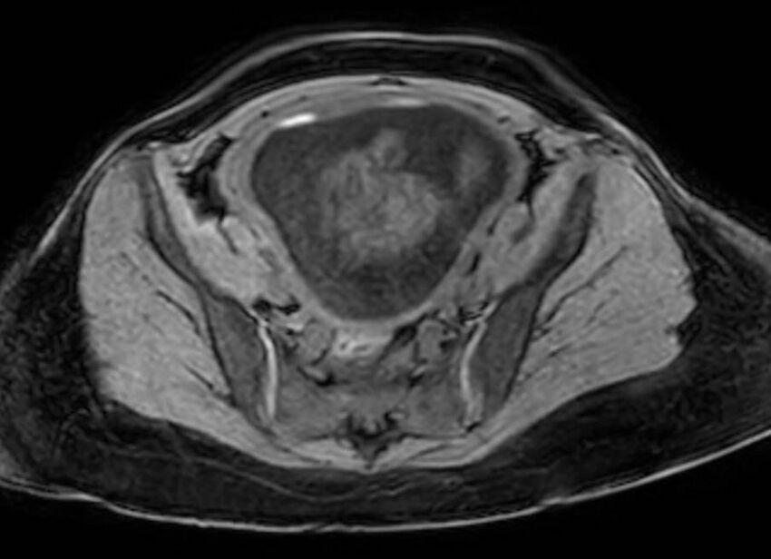 Appendicitis in gravida (MRI) (Radiopaedia 89433-106395 Axial DIXON 117).jpg