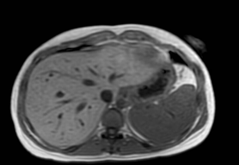 File:Appendicitis in gravida (MRI) (Radiopaedia 89433-106395 Axial T1 in-phase 6).jpg