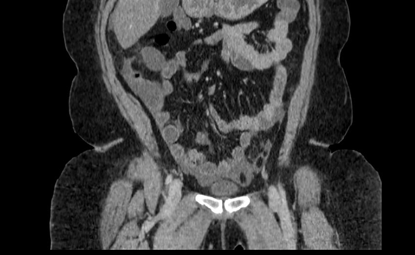 Appendix mucocele (Radiopaedia 41222-44033 B 19).jpg