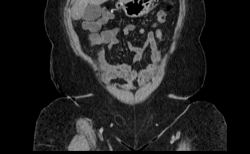 Appendix mucocele (Radiopaedia 41222-44033 B 4).jpg